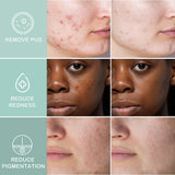 Acne Clearing Pimple Patches