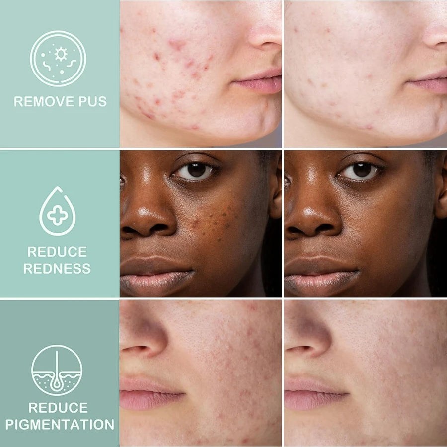 Acne Clearing Pimple Patches